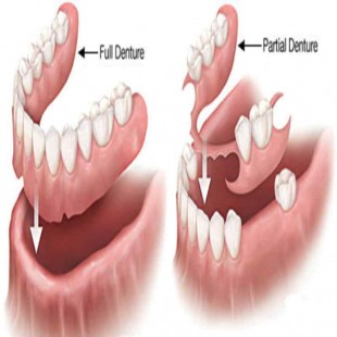 Image for Moulds (Complete  and partial denture)